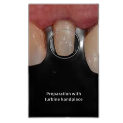 هندپیس-توربین