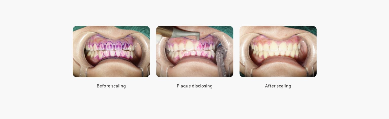 دستگاه ایرفلو وودپکر Woodpecker – AP-A Air polisher - پتوس